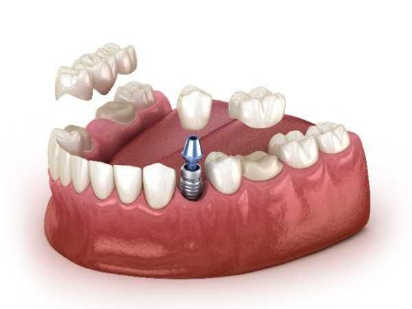 Invisalign Edinburgh
